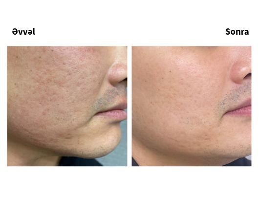 Lutronic Hollywood Spectra